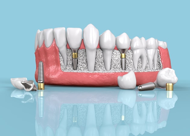 Dental Implants Restoration