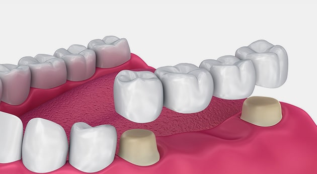 process of dental crown & bridges in Geneva, IL.