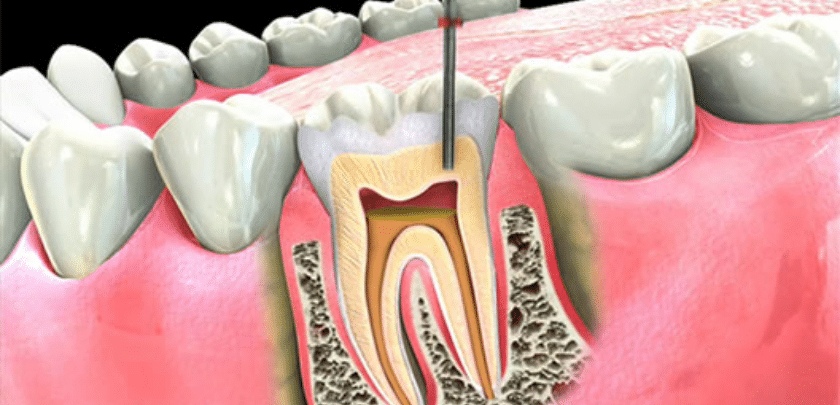 How Do You Treat An Infected Root Canal?