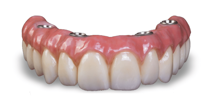 Full-mouth Dental Implants