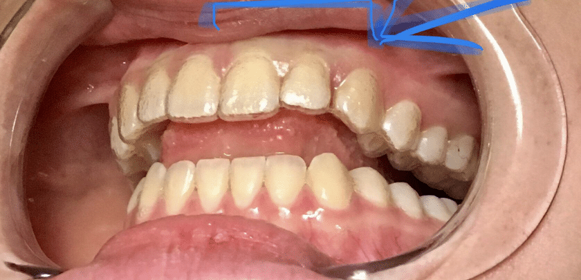 Invisalign from cutting my gums
