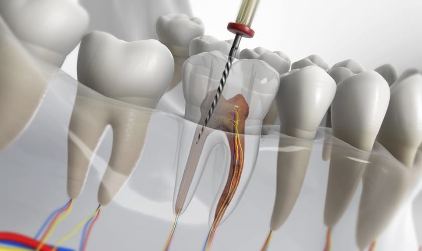What to expect after a root canal