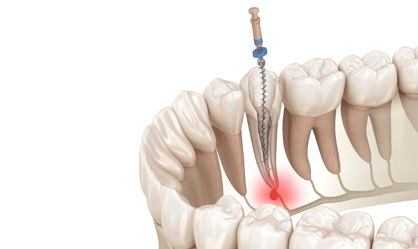 Root Canal Treatment